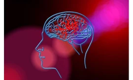 Tìm ra phương pháp mới có thể giảm nguy cơ tái phát đột quỵ 