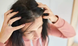 Tại sao chỉ sau một đêm có người bạc trắng đầu?