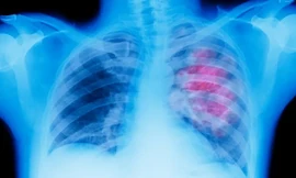 Không hút thuốc lá vẫn có nguy cơ cao mắc ung thư phổi? 