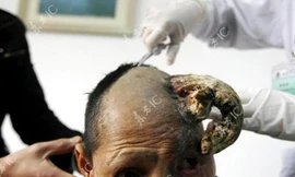 Một phụ nữ mọc sừng tại Trung Quốc