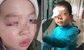 Cháu M được chẩn đoán mắt sẽ teo đi