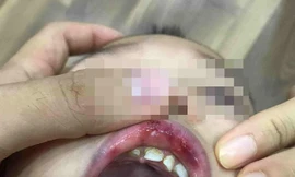 Điểm nhấn giáo dục: Cô giáo ở Hà Nội tát trẻ bầm dập, tụ máu môi