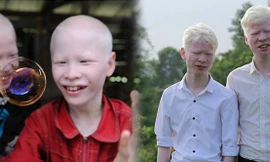 Cặp anh em bạch tạng hiếm hoi: Sự khác biệt chưa bao giờ là trở ngại