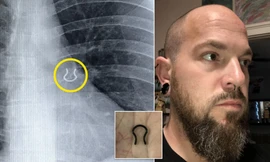 Tá hỏa phát hiện khuyên mũi mất 5 năm trước nằm lù lù trong... phổi