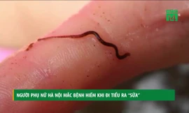 Người phụ nữ Hà Nội mắc bệnh hiếm đi tiểu ra 'sữa'