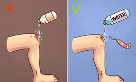 6 cách sơ cứu sai nhiều người vẫn tưởng là đúng