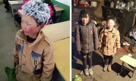 Cậu bé có mái tóc đóng băng ở Trung Quốc được ủng hộ hàng triệu USD