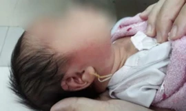 Xỏ khuyên tai, bé 15 ngày tuổi ở Tiền Giang suýt chết