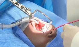 Bác sĩ cắt amidan như thế nào?