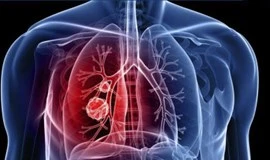 Ung thư sẽ được chẩn đoán bằng phần mềm riêng