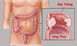 5 dấu hiệu thường gặp của ung thư đại tràng