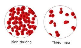 Vì sao khi thiếu sắt chúng ta lại bị thiếu máu?