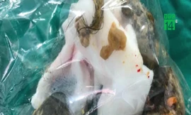 Mắc bệnh công chúa tóc mây, bé gái thích ăn tóc của mình