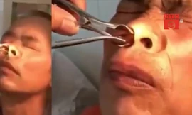 Rùng mình đỉa sống ngoe nguẩy trong mũi bệnh nhân