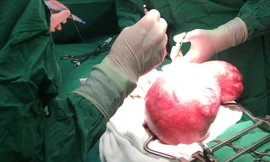 Cô gái mang khối u 4 kg trong bụng mà không biết