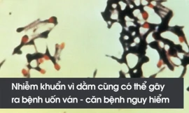 Nguy hiểm nhiễm khuẩn khôn lường từ những miếng dằm nhỏ xíu 