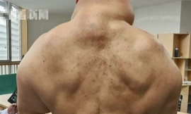 Cơ thể biến đổi dị dạng do uống rượu hàng ngày