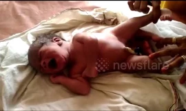 Em bé ra đời với 4 chân gây kinh ngạc