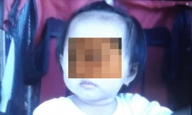 Bé T. vừa được các bác sĩ gắp ra một viên đá bằng đầu đũa nằm mắc kẹt trong mũi. Ảnh: Thanh Lâm