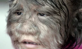 Một em nhỏ mắc hội chứng "người sói". Ảnh minh hoạ: EPA