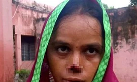 Chồng cắt mũi vợ vì không ‘cống nộp’ đủ tiền hồi môn