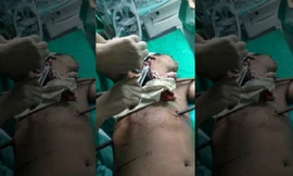 Pal bị hai thanh sắt đâm xuyên cơ thể sau cú ngã tại công trường xây dựng. Ảnh: Newslion.