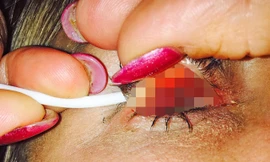 Sử dụng mascara trong thời gian dài đã khiến một người phụ nữ ở Australia suýt bị mù mắt.