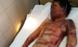 Dùng xăng nướng khoai, học sinh lớp 5 này hiện nguy kịch tính mạng do bỏng nặng.