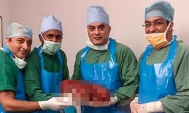 Các bác sĩ chụp ảnh cùng quả tận nặng 7,4kg. Ảnh: Bệnh viện Sir Ganga Ram