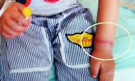 Vệt đỏ trên cổ tay Longlong trước khi phẫu thuật.