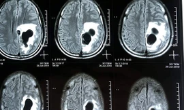 Sán làm tổ như chùm nho trong não vì nghiện món tiết canh