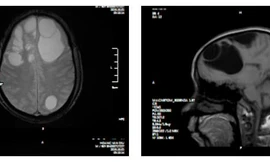 Phim chụp não cho thấy cả ổ sán trong não người bệnh