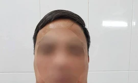 Bệnh nhân với khối u khi chưa được phẫu thuật. Ảnh: Bệnh viện Ung bướu Hà Nội cung cấp