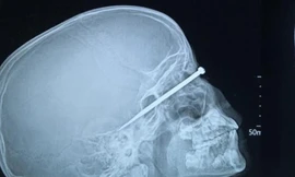 Dị vật đâm xuyên mắt em A.T. đã được lấy ra