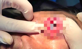 Cứu chữa bệnh nhân bị đinh sắt dài 5mm găm vào mắt