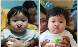 Cháu Khưu Kim Châu trước và sau khi được phẫu thuật. 