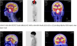 Chữa khỏi ung thư ở Việt Nam sau khi điều trị tại Singapore