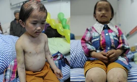 Bố giội nước sôi lên đầu, khâu miệng con gái