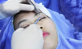 Các chuyên gia mắt cảnh báo, nhấn mí chìm (không khâu) cũng có thể tiềm ẩn rủi ro nguy hiểm cho thị lực thậm chí là tính mạng của bệnh nhân nếu được thực hiện ở cơ sở không đảm bảo (ảnh minh họa) Ảnh: PV