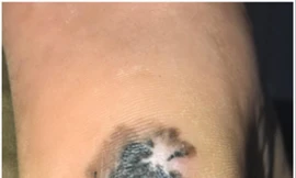 Đốm đen ở gót chân trở thành ung thư da 