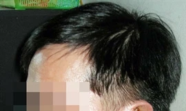 Phó Bí thư bị người tình xẻo tai làm đơn bãi nại