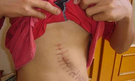 Người nghèo bán thận, được một, mất mười