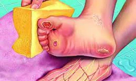 Bệnh đái tháo đường tê bì chân và nguy cơ tàn phế