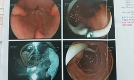 Ngỡ viêm dạ dày, ai ngờ 2 con sán 'làm tổ' trong tá tràng