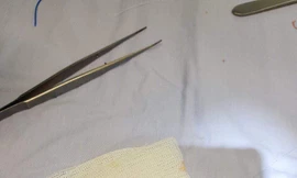 Bé gái thoát chết thần kì khi bút chì cắm vào mắt