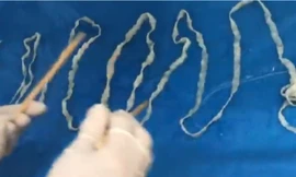 Kinh hãi con sán dài 5,2 mét ký sinh trong bụng cô gái