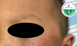 Bé trai 4 tuổi da bỏng rộp vì đồ chơi Halloween