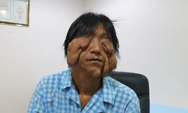 Mang khối u khổng lồ như 'mặt quỷ', người đàn ông 17 năm không dám ra khỏi nhà