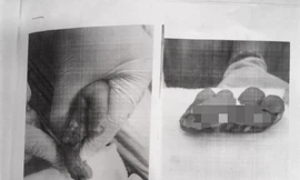 Bé trai 1 tuổi mất 4 ngón tay vì người lớn lơ là