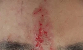 Mù mắt vì tiêm filler nâng mũi